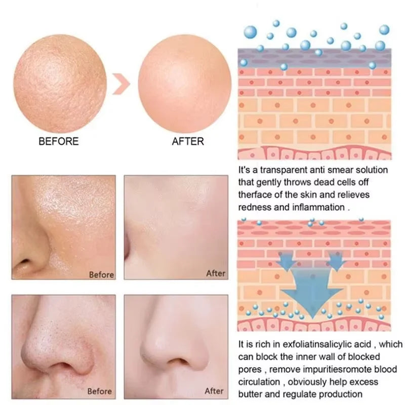 Lactic Acid Large Pores Removal Serum Fast Pore Shrinking Minimizing Essence Moisturizing Firming Smooth Repair Korean Skin Care