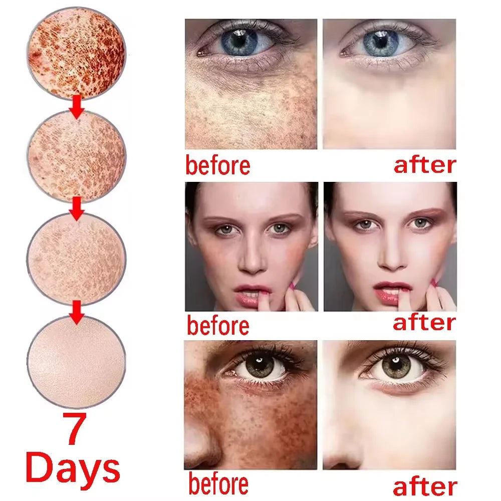 Niacinamide Dark Spots Remover Serum Face Freckle Melanin Correcting Essence Anti Pigmentation Whitening Brighten Dull Skin Care