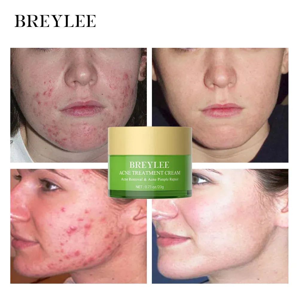 BREYLEE 20g Acne Treatment Cream Anti Acne Face Cream Pimple Removal Spots Oil Control Shrink Pores Moisturizing Skin Care Serum