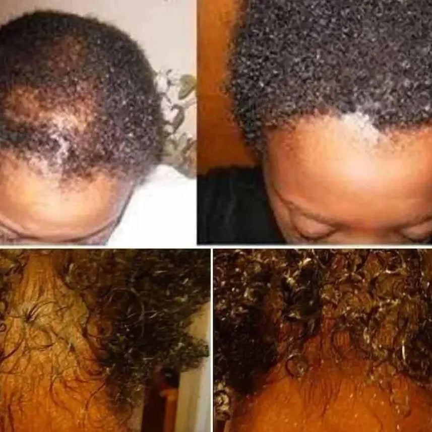 Rosemary Fast Hair Growth Shampoo Anti Hair Loss Products Repair Scalp Follicles Onion Hair Regrowth Shampoo For Women For Men