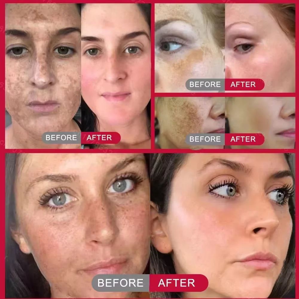 Niacinamide Dark Spots Remover Serum Face Freckle Melanin Correcting Essence Anti Pigmentation Whitening Brighten Dull Skin Care