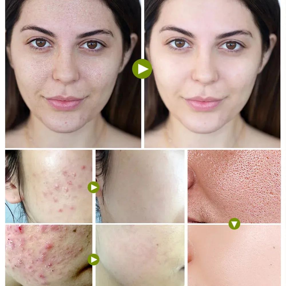 BREYLEE 20g Acne Treatment Cream Anti Acne Face Cream Pimple Removal Spots Oil Control Shrink Pores Moisturizing Skin Care Serum