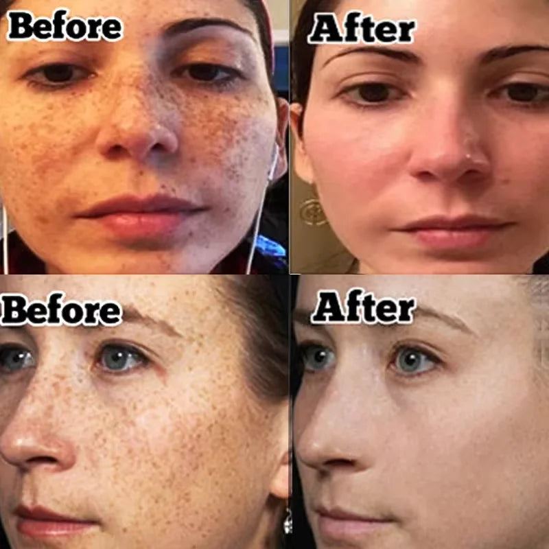 Niacinamide Dark Spots Remover Serum Face Freckle Melanin Correcting Essence Anti Pigmentation Whitening Brighten Dull Skin Care
