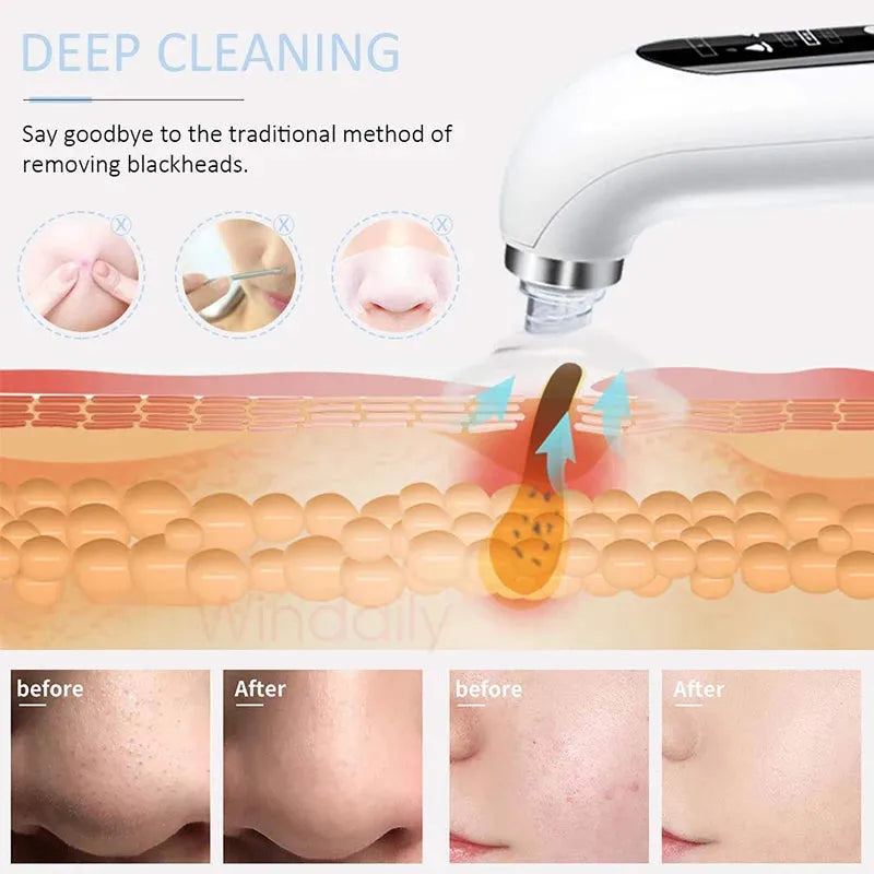 Electric Facial Blackhead Remover Vacuum Pore Cleaner Acne Cleanser Black Spots Removal Face Nose Deep Cleaning tools