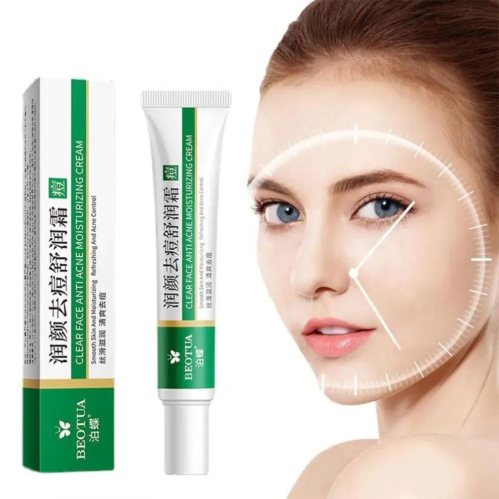 Herbal Acne Face Cream Pimple Scar Removal Gel Oil Control Shrink Pore Smooth Acne Marks Facial Cream Skin Care Product