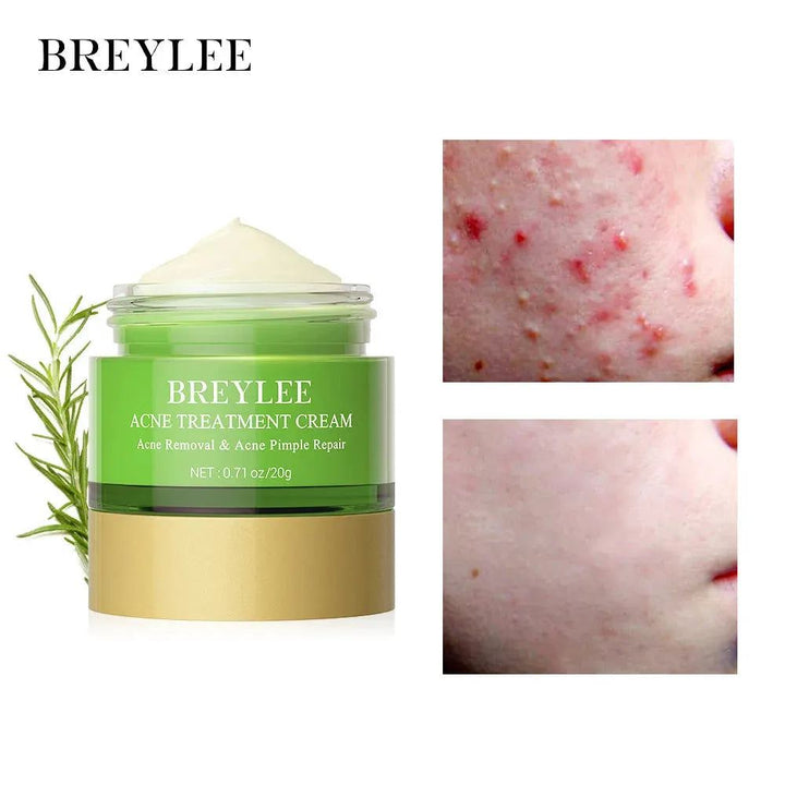 BREYLEE 20g Acne Treatment Cream Anti Acne Face Cream Pimple Removal Spots Oil Control Shrink Pores Moisturizing Skin Care Serum